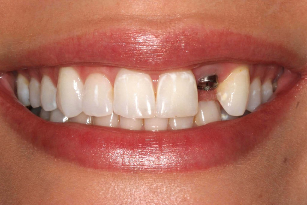 Dental Implants Southport 10 Dental