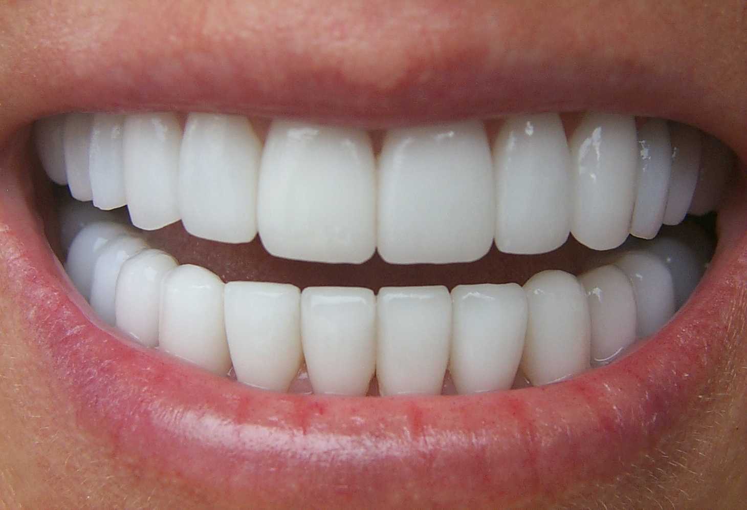 thumbnail image 2 of Temporary Teeth Veneers - 3 Sizes, 12 Positions, SL Ceramic For Anterior Whitening 2 of 10